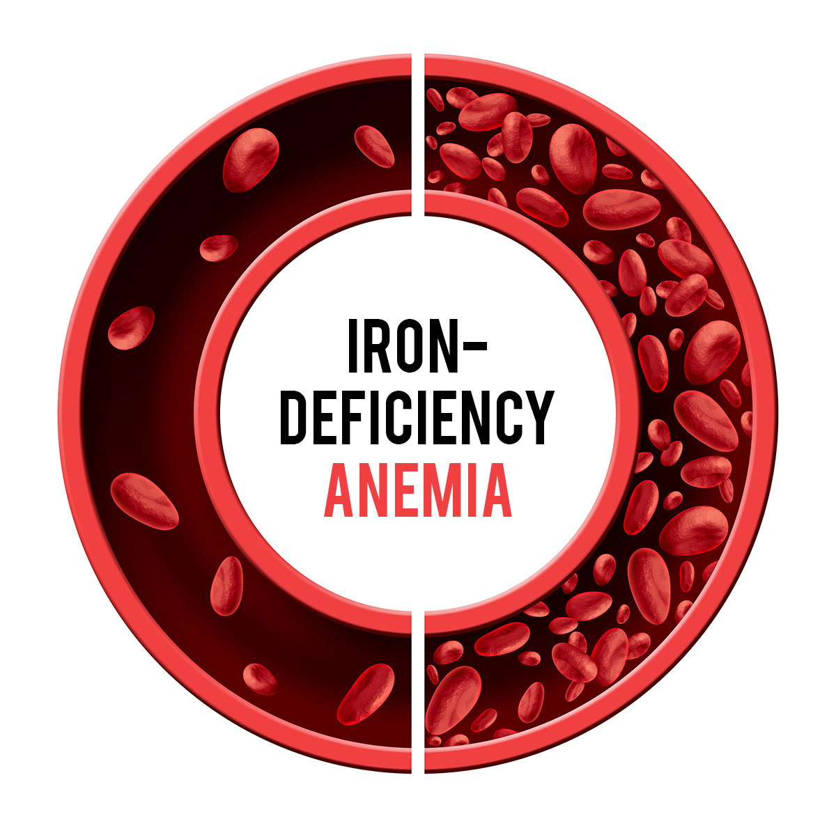 Anemia (low iron) Can Prevent You From Losing Weight